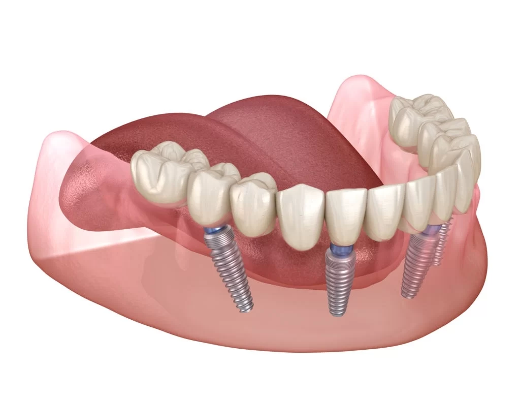 implants-overdentures-regency-1
