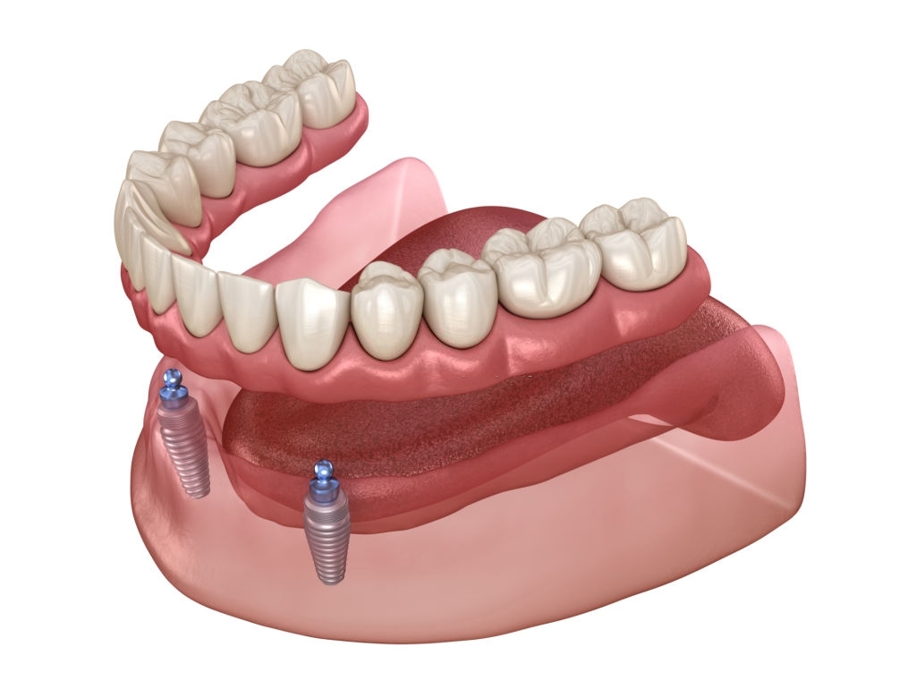 Mandibular removable prosthesis All on 2 system supported by implants with ball attachments. Medically accurate dental 3D illustration